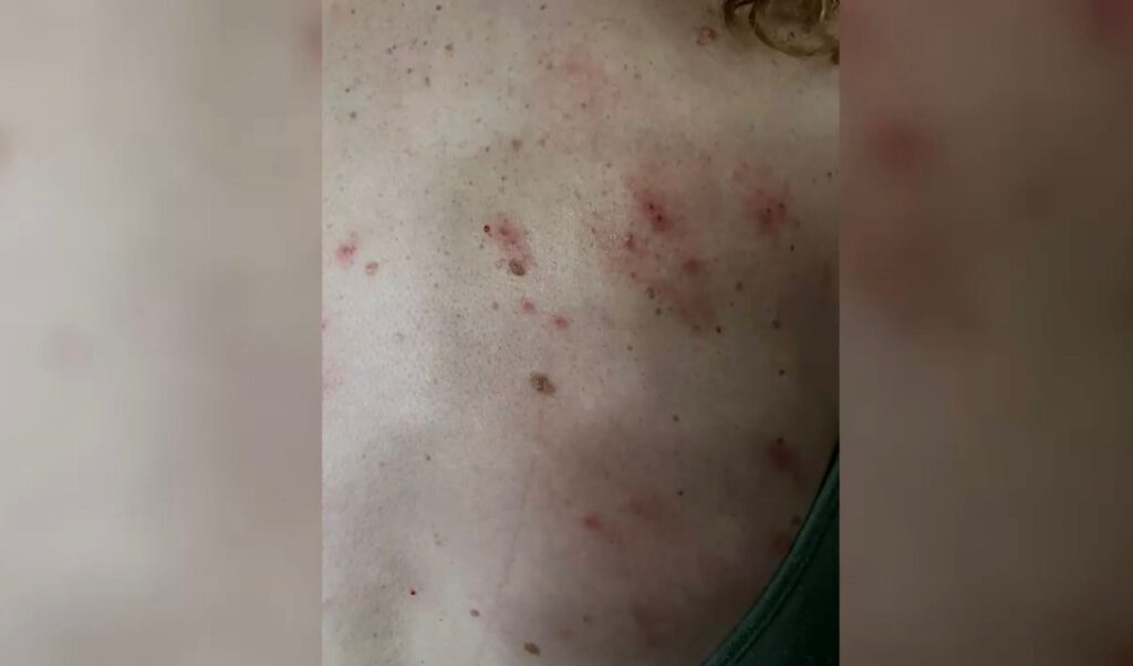 Crisis de Chinches en El Paso: Madre Lucero Castro Alza la Voz por Riesgo Sanitario