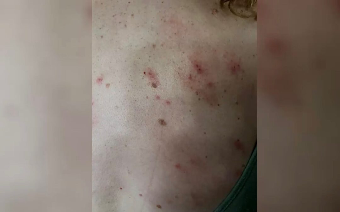 Crisis de Chinches en El Paso: Madre Lucero Castro Alza la Voz por Riesgo Sanitario